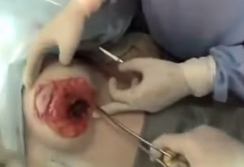 Có những ca, bác sĩ phải mổ vết rất sau như thế này. Vì vậy, khi hết thuốc gây tê, bệnh nhân sẽ phải trải qua cảm giác vô cùng đau đớn. Ảnh: youtube