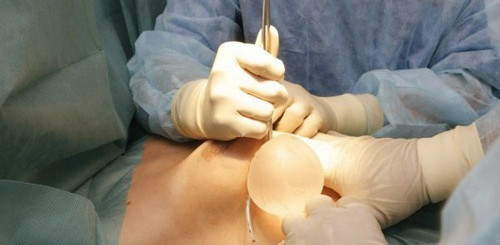 Sau đó, bác sĩ sẽ trực tiếp đưa túi chất lỏng vào bên trong ngực. Ảnh: bomnguc