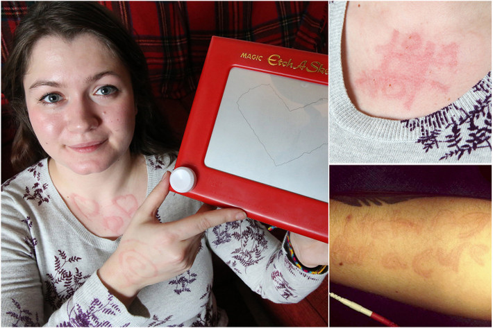 Cô gái Hannah Arbuthnott, 21 tuổi bị một dạng bệnh mề đay có tên dermatographia. Khi một người mắc chứng bệnh hiếm gặp dermatographia có một vết trầy xước trên da của mình, máu sẽ được gia tăng đưa đến nơi trầy xước hơn bình thường. Dermatographia có các triệu chứng như đỏ, ngứa và sưng.