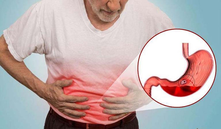Phân đen, khó thở, đau ngực, đau bụng, ngất xỉu, máu nôn có thể có màu đỏ hoặc có thể có màu nâu sẫm là những dấu hiệu phổ biến của xuất huyết dạ dày. Ảnh: soytebackan.