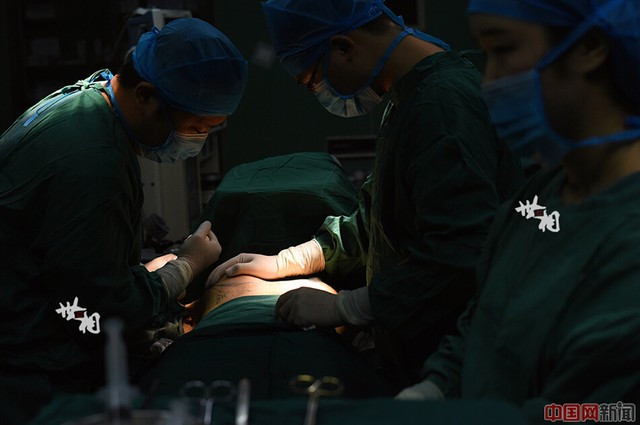 Sau 10 phút phẫu thuật, 1 bên ngực của Wang đã có kích thước cup C.