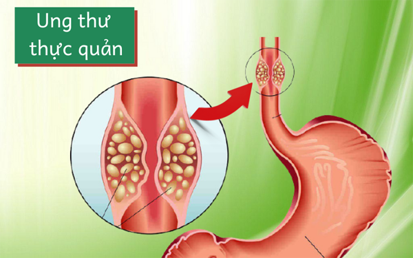 Cách đây nửa tháng, Vương đang ăn thì cảm thấy thực quản đau dữ dội. Người nhà vội đưa anh đến Bệnh viện Nhân dân số 2, Đại học Y Cáp Nhĩ Tân. Sau thăm khám, bác sĩ phát hiện khối u có đường kính 3cm cách răng cửa 28cm. Kết quả sinh thiết cho thấy đây là khối u do ung thư thực quản.