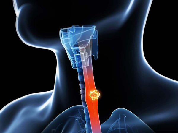 Phát hiện và điều trị sớm ảnh hưởng lớn đến khả năng sống của bệnh nhân. Năm 2015, tỷ lệ sống sót sau 5 năm được chuẩn hóa theo độ tuổi của bệnh ung thư thực quản ở Trung Quốc là 30,3%. Ở đó, tỷ lệ sống sót sau 5 năm phát hiện bệnh ở giai đoạn đầu là 95%. Trong khi đó, tỷ lệ sống sót sau 5 năm rất thấp.