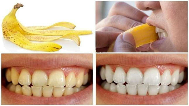Dùng mặt trong của vỏ chuối chà nhẹ lên răng 2 - 3 lần mỗi tuần, răng bạn sẽ trắng sáng lên trông thấy.