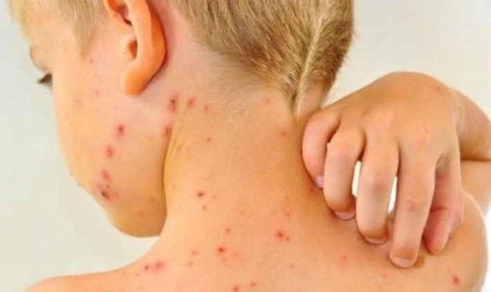 Do đó, chế độ ăn uống của người bị bệnh sởi cần đảm bảo đủ 4 nhóm thực phẩm: bột đường, đạm, béo, vitamin và khoáng chất. Ảnh: baophapluat.