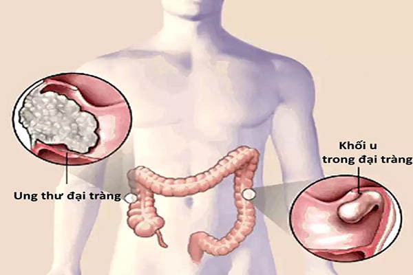 Phân mỏng, hẹp hơn so với bình thường cũng có thể là một dấu hiệu của ung thư đại tràng. Ảnh: baosonhospital.