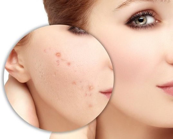 Thoa vitamin E lên mặt còn mang lại hiệu quả xóa sẹo ấn tượng. Làm được điều này là nhờ vitamin E có tác dụng chống oxy hóa, giúp phục hồi tế bào da ổn thương, thúc đẩy tái tạo tế bào mới, đẩy nhanh quá trình bong tróc và thoái hóa của da cũ. Kiên trì dùng vitamin E thoa lên mặt, vết sẹo sẽ được làm mềm, tạo các tế bào mới thay thế tế bào bị hỏng, mang lại hiệu quả xóa sẹo.