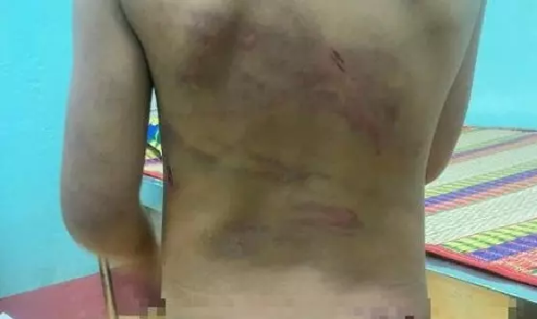 Bé gái 7 tuổi nghi bị bạo hành ở Bình Phước: Ngày 28/7, Trung tâm y tế huyện Đồng Phú đã tiếp nhận và đang theo dõi sức khỏe cho bé L.Y.D. (7 tuổi, quê Nghệ An, ngụ tại xã Tân Hòa, huyện Đồng Phú, tỉnh Bình Phước). Bước đầu cơ quan chức năng xác định bé D mới từ quê vào Bình Phước để ở với mẹ là chị Lầu Y Lầu (25 tuổi) và cha dượng là Trần Thanh Tú (23 tuổi). Trước đó, một người phụ nữ cho biết, vào chiều 27/7, chị đi chợ về rồi qua nhà bé gái hàng xóm để cho bánh kẹo. Lúc nhìn vào người bé thì thấy nhiều vết bầm tím khắp lưng và vùng mông. Bức xúc, chị này đã chụp lại hình ảnh, đồng thời thông báo cho chính quyền địa phương.