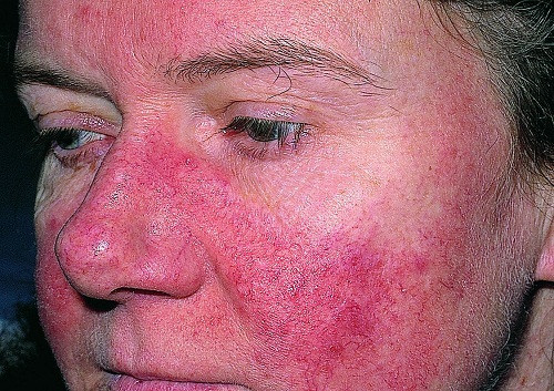 Bệnh lupus ban đỏ là bệnh lý của mô liên kết có tổn thương nhiều cơ quan do hệ thống miễn dịch của cơ thể bị rối loạn, đặc trưng bởi sự có mặt của kháng thể kháng nhân và nhiều tự kháng thể khác. Các cơ quan thường bị tổn thương bao gồm khớp, da, thận, tế bào máu, tim, phổi, thần kinh…