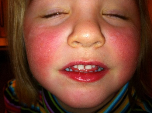 Những triệu chứng ban đầu của bệnh lupus ban đỏ là sốt, mệt mỏi, chán ăn, gầy sút. Những biểu hiện này có thể xuất hiện đột ngột hoặc từ từ theo thời gian.