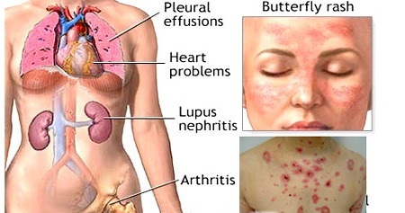 Lupus ban đỏ tác động lên nhiều cơ quan trong cơ thể: hệ cơ xương khớp, da, tóc, thận, tim mạch, hệ thần kinh , phổi, hệ miễn dịch , hệ tiêu hóa, mắt...nên biểu hiện triệu chứng rất đa dạng và thường nặng lên vào mùa đông.