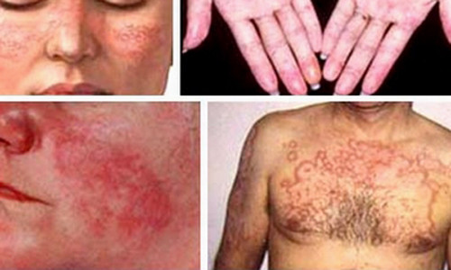 các triệu chứng thường mơ hồ và giống với nhiều bệnh lý khác cho nên kể từ lúc có những triệu chứng đầu tiên cho đến khi bệnh được chẩn đoán chính xác có thể phải mất vài năm. Nhiều người từng bị điều trị oan cả năm, thậm chí vài năm các bệnh khác như dị ứng, thấp khớp, bệnh mắt, thận... dẫn đến nguy hiểm đến tính mạng.