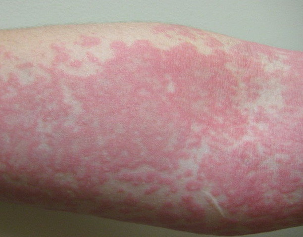 Bệnh lupus thường gây tổn thương da: khoảng 2 /3 số bệnh nhân mắc lupus có biểu hiện trên da, được gọi là lupus ban đỏ trên da. Bệnh gây phát ban hay xuất hiện các vết lở loét, thường gặp ở những vùng da hay tiếp xúc với ánh sáng như: mặt, cổ, cánh tay và chân.