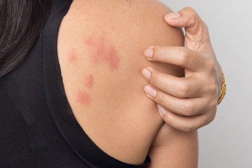 2. Ngứa da. Mắc các bệnh ngoài da như mề đay, chàm, dị ứng... cơ thể sẽ có biểu hiện ngứa, phát ban cục bộ. Những rắc rối này có thể giải quyết khi sử dụng các loại thuốc đặc trị.