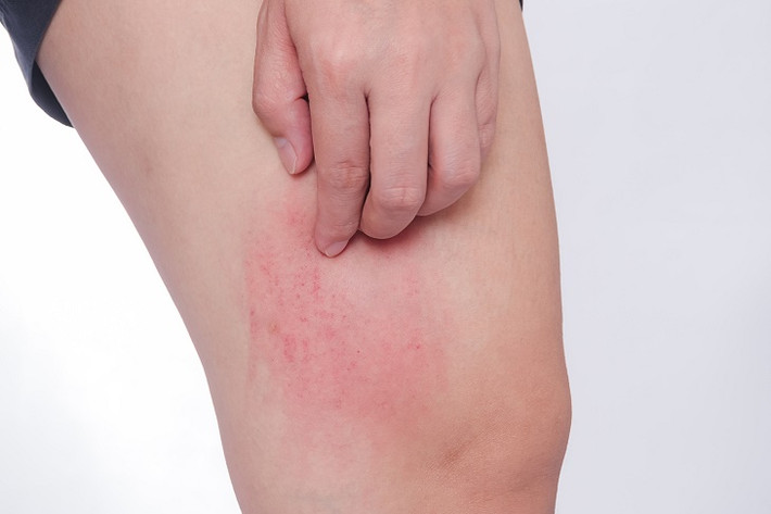 Nguyên nhân tình trạng bắt nguồn từ việc lượng đường trong máu tăng cao, lượng đường trong dịch mồ hôi tiết ra cũng tăng theo. Điều này tạo điều kiện cho vi khuẩn và nấm phát triển. Sức đề kháng của da lúc này cũng suy yếu, người bệnh dễ có cảm giác khó chịu, ngứa ngáy.