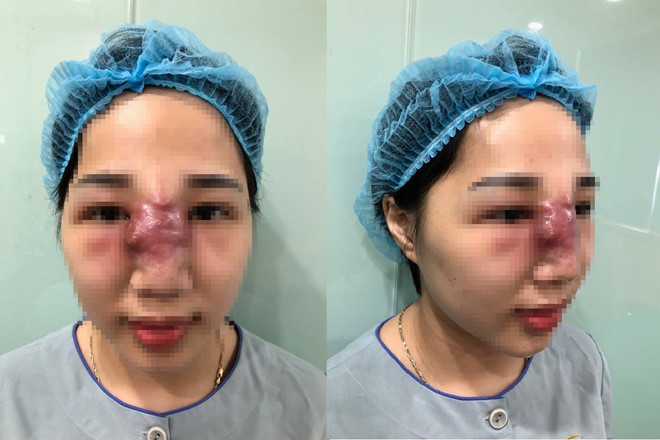 Vùng mũi của bệnh nhân bị viêm nặng, mưng mủ, hoại tử gần như toàn bộ sống mũi sau khi tiêm chất làm đầy (filler) để nâng mũi tại một spa ở Hà Nội.