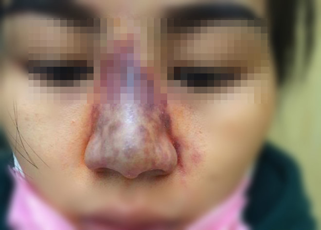 Một phụ nữ ở Hưng Yên tiêm filler nâng mũi tại một cơ sở spa gần nhà bị biến chứng sưng đỏ, dần chuyển sang bầm tím, có dầu hiệu hoại tử.