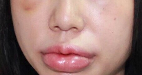 10 ngày sau khi tiêm chất làm đầy ở môi, mắt và thái dương, bệnh nhân T.T.H (Hà Nội) phải tìm đến Bệnh viện Da liễu Trung ương trong tình trạng khuôn mặt sưng nề, môi căng bóng, sờ có khối chắc và vết rò ở môi trên và môi dưới. Sau khi thăm khám, bác sĩ chẩn đoán bệnh nhân gặp phải phản ứng u hạt khi tiêm filler.