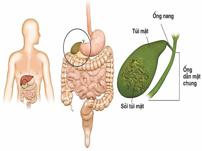 Sỏi mật: Sỏi mật là hệ quả của việc giảm cân không lành mạnh. Thông thường, sỏi mật có liên quan đến những người béo phì hoặc thừa cân. Tuy nhiên, trong một số trường hợp, khi mọi người giảm cân không lành mạnh bằng cách ăn kiêng và tập thể dục quá sức, mật không được thải ra khỏi cơ thể đúng cách. Điều này có thể làm cho mật trong gan cứng lại và hình thành các lớp đá, được gọi là sỏi mật. Tình trạng này có thể phải phẫu thuật!
