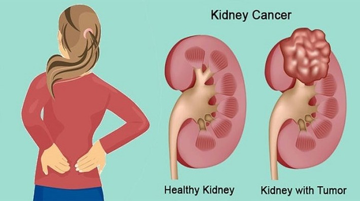 Ung thư: Theo một số nghiên cứu, giảm cân nhanh chóng bằng cách tước đi các chất dinh dưỡng của cơ thể cũng có thể kích hoạt một số loại ung thư, chẳng hạn như ung thư vú, ung thư thận, ung thư đại tràng,...