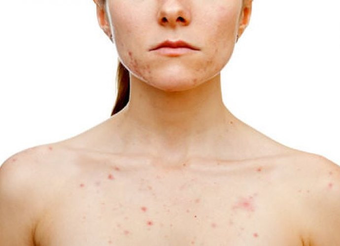 Mụn trứng cá và nổi mụn trên da rất phổ biến trong thời gian kinh nguyệt do có sự gia tăng hormone giới tính và androgen trong cơ thể. Nó làm cho các tuyến dầu của da hoạt động quá mức, làm cho các lỗ chân lông bị tắc nghẽn. Giữ vệ sinh sạch, mụn sẽ nhanh biến mất.