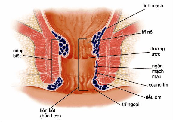 Khi bị trĩ, xuất huyết. Đặc biệt khi bị chảy máu thưởng xuyên. Bất kỳ bị chảy máu ở chỗ nào (xuất huyết tử cung, chảy máu mũi thường xuyên) cũng chống chỉ định dùng gừng bởi sẽ làm tăng tình trạng chảy máu.