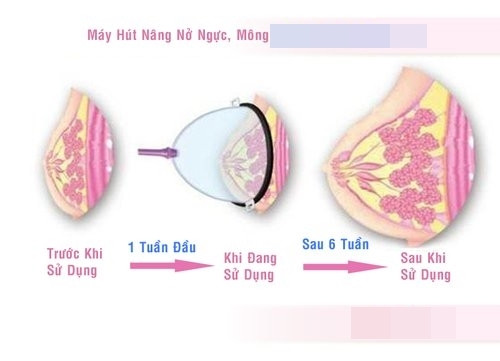 Tuy nhiên, Bác sĩ thẩm mỹ Nguyễn Vũ Phương Ngọc (tu nghiệp tại Thái Lan, nguyên giảng viên khoa Phẫu thuật tạo hình thẩm mỹ - Đại học Y khoa Phạm Ngọc Thạch, TP.HCM) cho biết: "Phương pháp này chắc chắn không có tác dụng. Hình dáng ngực to và đầy hơn sau khi tác động chỉ là hiện tượng sưng viêm...