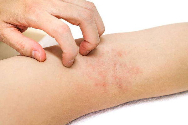 Khi gan bị tổn thương, chất độc chuyển hóa sẽ không được thải trừ, tích tụ lại trong cơ thể. Các chất này tích tụ dưới da sẽ gây phản ứng viêm gây ngứa. Ngứa do tổn thương gan thường có các biểu hiện như nổi mẩn như phát ban. Vị trí ngứa có thể ở cổ, tay hoặc toàn thân; nổi sẩn rải rác hoặc tập trung thành đám.