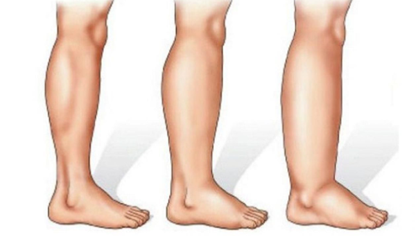 Phù nề toàn thân. Khi nhiễm độc niệu, cơ thể khó duy trì quá trình trao đổi chất bình thường. Nguyên nhân bắt nguồn từ tình trạng chức năng thận suy giảm, không thể thải kịp thời lượng nước dư thừa trong cơ thể ra ngoài. Trước khi phù nề toàn thân, người bệnh thường đối diện tình trạng sưng mí mắt, mắt cá chân.