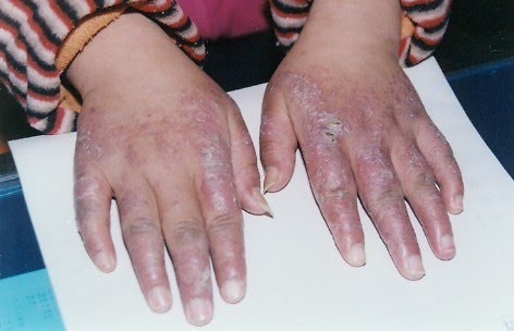 Không nên gãi. Khi bị cước bạn sẽ có cảm giác ngứa ngáy, khó chịu, khi ấy bạn không nên gãy vì càng gãi bạn sẽ càng thấy ngứa và lúc đó da sẽ bị tổn thương dễ gây viêm nhiễm. Trong trường hợp này chỉ nên xoa bóp nhẹ nhàng để tranh nguy cơ bị trầy xa, xước da.