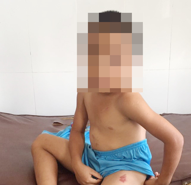 Trước đó, Vũ đã 5 lần dùng điếu thuốc lá đang cháy châm vào nhiều vị trí trên cơ thể của cháu H. như mặt, đùi khiến cháu bị sưng nề ở vùng đầu, ôm cháu H. quăng xuống nền xi măng khiến cháu bị sưng nề ở vùng đầu...