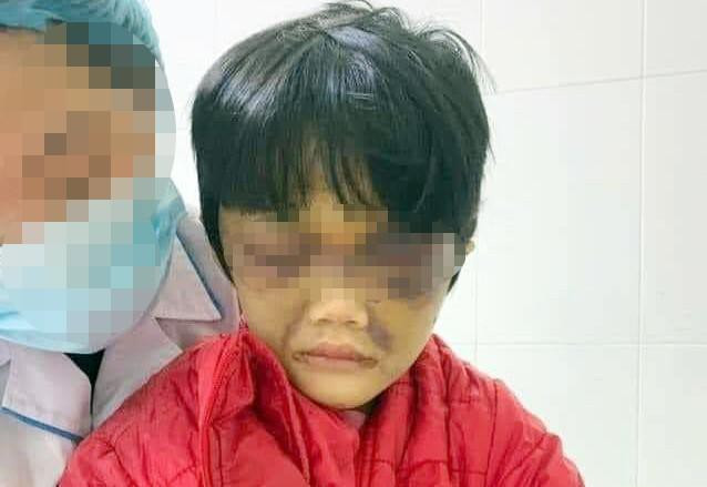 Cháu C. bị chấn thương gãy xương chính mũi; chấn thương phần mềm gây bầm tím, bong tróc da vùng hai mắt, má trái, cằm trái, cẳng tay phải, cẳng tay trái. Tỷ lệ tổn thương cơ thể cháu C. do thương tích gây nên là 7%.