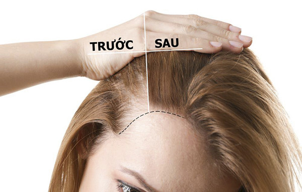 Bên cạnh đó, các chất trong cà phê còn có thể hỗ trợ tế bào tóc sản xuất nhiều hợp chất hữu cơ hơn giúp sợi tóc nhanh dài, kích thích mọc tóc.