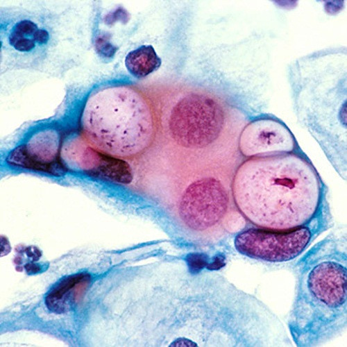 Bệnh lây qua đường tình dục. Các bệnh lây truyền qua đường tình dục như chlamydia và bệnh lậu có thể dẫn đến viêm xương chậu và khó thụ thai. Thực tế, khuẩn chlamydia có thể gây viêm ống dẫn trứng mà không có biểu hiện gì khác. Nhiều chị em không biết có bệnh đến khi khó có bầu. Ngoài ra, viêm âm đạo không dẫn đến vô sinh.