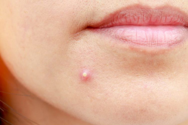 Trong khi đó, mụn trứng cá chủ yếu do tác động của nội tiết tố. Chăm sóc da mặt, ăn uống sinh hoạt hợp lý sẽ cải thiện đáng kể tình trạng da.