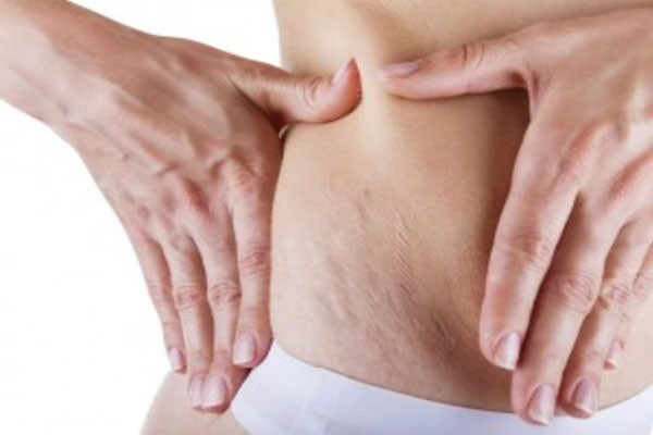 4. Nước chanh. Nước ép chanh tự nhiên có vị chua giúp chữa lành và làm giảm vết rạn da, mụn trứng cá và các vết sẹo khác. Thấm nước chanh vào da ít nhất 10 phút trước khi rửa nước ấm. Cách khác là trộn nước ép dưa chuột và nước cốt chanh để thoa lên vết rạn cũng rất hữu hiệu.