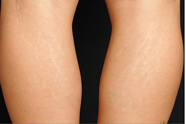 Lúc này, các collagen suy yếu, ảnh hưởng đến chu kỳ sản xuất collagen bị gián đoạn và hư hỏng, cuối cùng dẫn đến sẹo dưới các lớp trên cùng của da. Ban đầu vết này hồng hoặc đỏ, nhưng theo thời gian nó xuất hiện trên bề mặt da và đó là rạn da.
