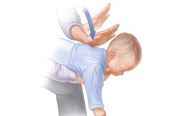 Tốt nhất cha mẹ nên bóc tách hoặc hướng dẫn các em bóc hạt và ăn từ từ, tránh ngậm trong miệng rồi đi chơi hay chạy nhảy. Nếu trẻ bị hóc nặng, đầu tiên cha mẹ cần dốc ngược người con và vỗ mạnh vào lưng trẻ để vật hóc có thể bắn ra ngoài.