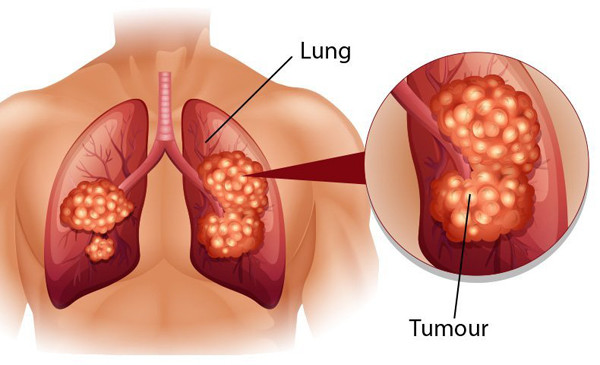 Thông qua trường hợp bệnh của ông Dương, bác sĩ nhấn mạnh ung thư phổi là căn bệnh nguy hiểm, thường được phát hiện muộn. Phát hiện bệnh ở giai đoạn cuối khiến việc điều trị khó mang lại hiệu quả mong muốn.