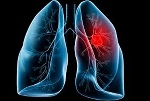 Đó là lý do người bị ung thư phổi có những cơn đau ở vai, cổ và lan xuống cả phần cánh tay phía dưới. Trái với những cơn đau cơ bắp, đau ở cánh tay do ung thư phổi tương tự như viêm khớp hoặc dây thần kinh bị chèn ép. Các cơn đau không giảm bớt khi người bệnh ngồi, đứng.