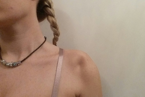 Bệnh lạ có tên Ehlers Danlos. Biểu hiện bên ngoài là da và mô lỏng lẻo, da cũng thường xuyên thâm tím sưng vù. Các collagen sản sinh rất thất thường, do đó các khớp thường xuyên bị xô lệch khi di chuyển hoặc kể cả không làm gì.