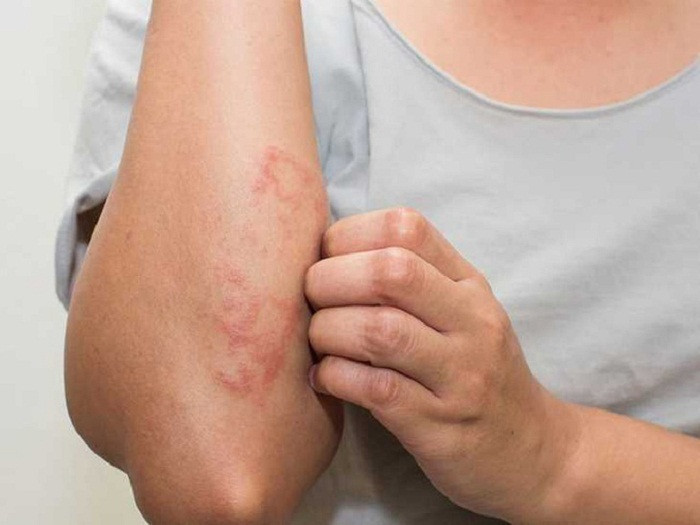Ngứa da. Một dấu hiệu ung thư gan khác là ngứa da. Điều này là do khối u của bệnh nhân ung thư gan đã đè nén ống mật, dẫn đến vàng da, vàng da tắc nghẽn và bài tiết mật kém, dẫn đến ngứa da.
