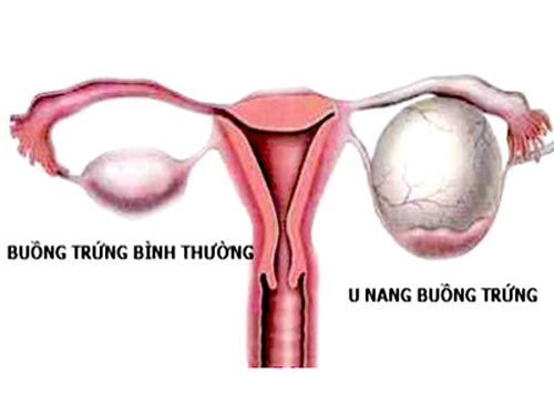 U nang buồng trứng là hiện tượng trên buồng trứng có tồn tại một khối u phát triển bất thường. Khối này có thể là tổ chức mới khác với tổ chức buồng trứng bình thường hay là sự tích tụ dịch tạo thành một nang trên buồng trứng.