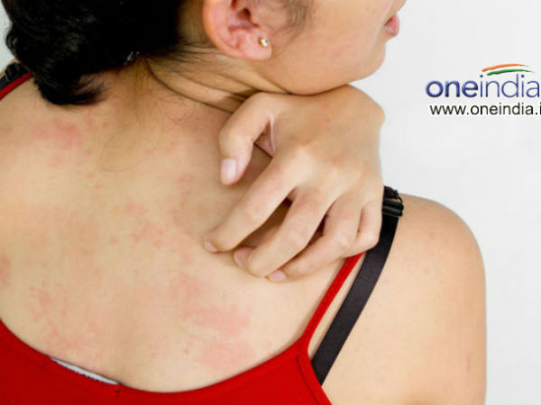 Dị ứng da. Dị ứng da là một trong những tác dụng phụ sau khi uống thuốc tránh thai. Tuy nhiên, uống quá liều có thể gây sưng, phát ban, ngứa liên tục trên da.