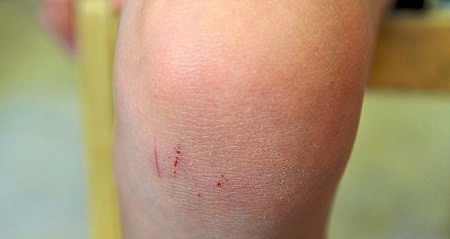 Bên cạnh đó, không được dán ở nơi có vết trầy xước. Không nên cho thuốc dính phải vào thức ăn gây ra tình trạng ngộ độc không mong muốn.