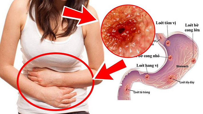 Viêm loét dạ dày là vết lở gây tổn thương xuất hiện ở niêm mạc dạ dày, xảy ra khi lớp chất nhầy dày bảo vệ dạ dày khỏi dịch axit tiêu hóa bị giảm. Điều này khiến các axit tiêu hóa ăn mòn các mô lót dạ dày, gây loét.