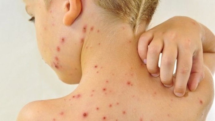 Các bệnh về da. Điều kiện vệ sinh kém, môi trường, nguồn nước bị ô nhiễm, chứa nhiều vi khuẩn gây bệnh các bệnh ngoài da như nấm kẽ chân, ghẻ, viêm nang lông, nước ăn chân (do nấm kí sinh gây ra), mẩn ngứa…