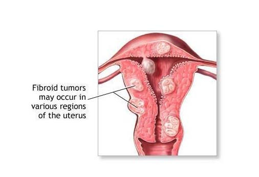 Các khối u âm đạo thường nhỏ và có thể điều trị bằng phẫu thuật, xạ trị cũng được áp dụng. Những phụ nữ đã từng có mụn cóc sinh dục có khả năng bị ung thư này cao hơn những người khác.