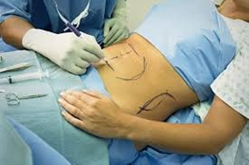 Hút mỡ giảm cân. Đây là giải pháp loại bỏ lượng mỡ thừa của cơ thể nhiều bạn gái tin dùng, nhưng lại tiềm ẩn nhiều biến chứng nguy hiểm, đe dọa đến sự phát triển bình thường của các cơ quan khác. Ảnh: Amíaim.