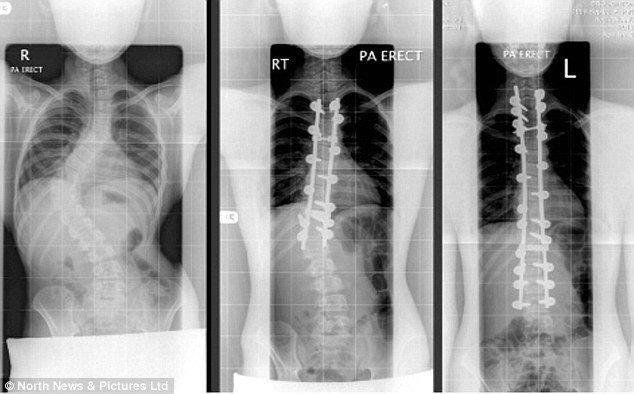 Các bác sĩ cho hay trường hợp của Amy cực kỳ nghiêm trọng bởi cột sống uốn cong thành góc 70 độ. Thậm chí các chuyên gia cũng cảnh báo cô bé có thể bị tê liệt vĩnh viễn và bị nghiền nát nội tạng do cột sống uốn cong.